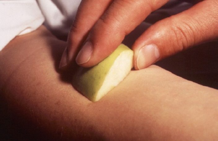 direkte Allergietestung auf der Haut