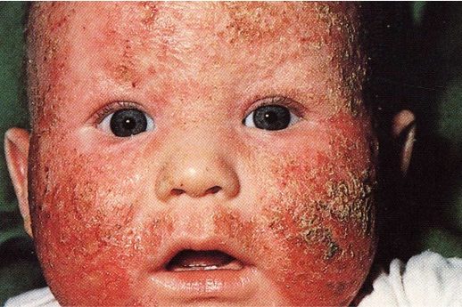 Etagenwechsel, Allergiesymptome